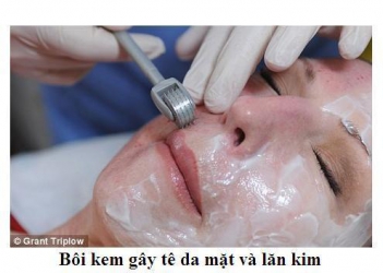 Điều trị sẹo lõm do mụn trứng cá bằng công nghệ lăn kim- tế bào gốc - nấu món ngon